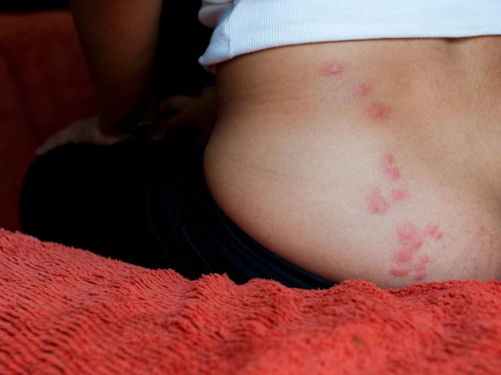 Bed Bug Bites: What They Look Like, Treatments, Prevention Tips
